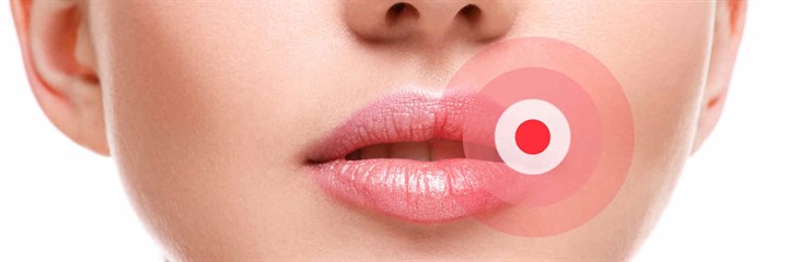 Close up of lips affected by Herpes simplex virus